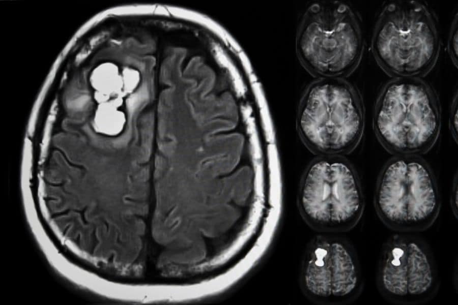 %neurocirurgiao em brasilia%
